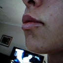 next day after treatment